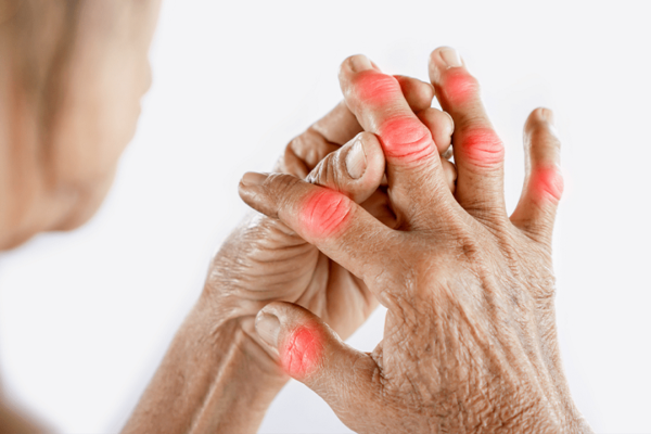 Management Of Arthritis