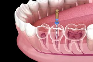 Root Canals