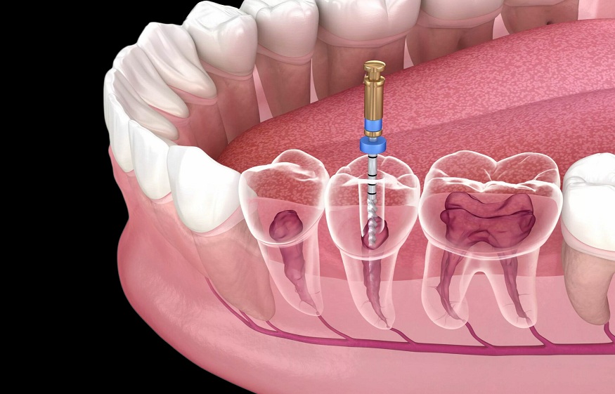 Root Canals