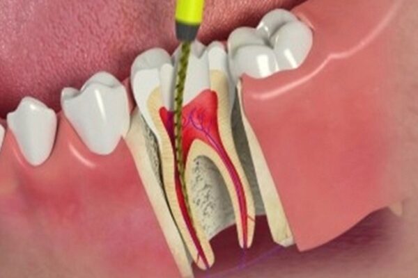 Root Canal Treatment