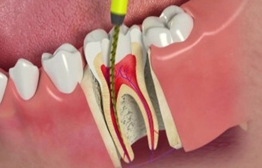 Root Canal Treatment